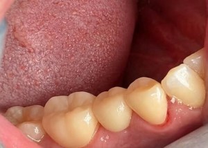Bridge insert after procedure
