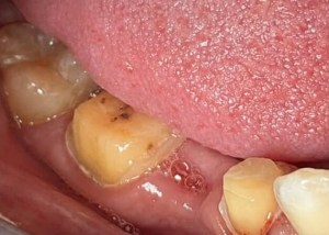 bridge insert before procedure