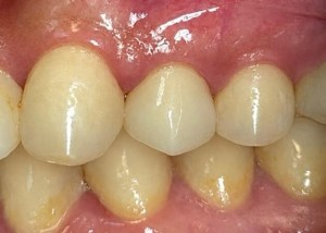 crown insert after procedure