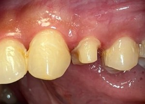 crown insert before procedure