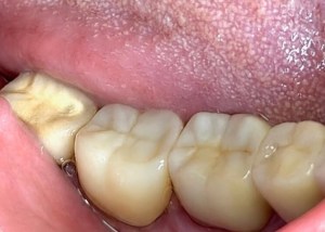 crown insertion after procedure