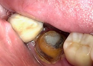 Crown insertion before procedure