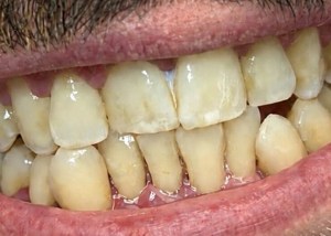 scaling and root planing after procedure