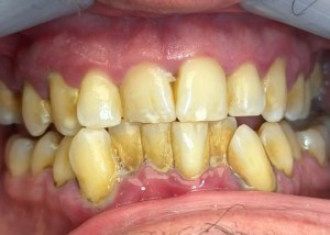 scaling and root planing before procedure